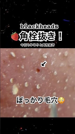 鼻の角栓をピンセットで抜くだけの動画。blackheads・comedones・去黑头・각마개#いちご鼻 #毛穴除去