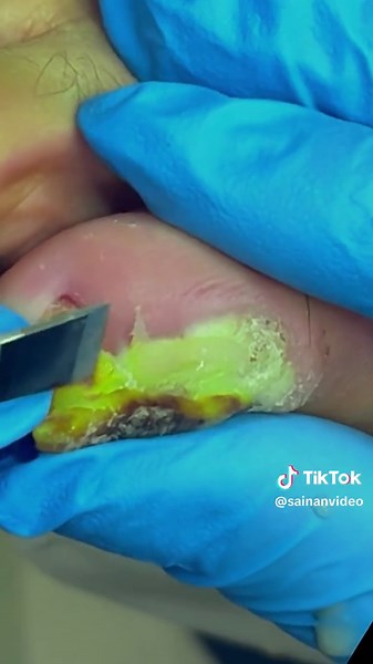 Treating Infected Big Toe: Care Tips and Techniques