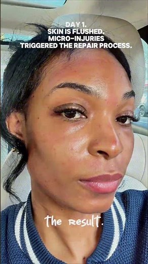 Microneedling before/after progress ✨