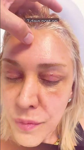 3 Weeks Post-Op: Endoscopic Brow Lift & Upper Blepharoplasty Healing Update