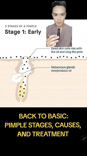 Understanding Pimple Stages, Causes, and Treatment