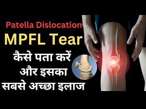 #MPFL Tear कैसे पता करें, सबसे अच्छा इलाज, #Patella Dislocation Causes, Symptoms, Best Treatment