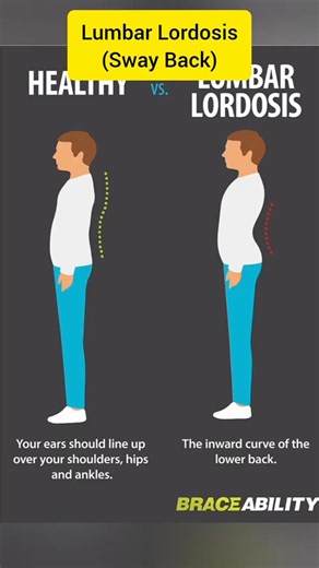 Lumbar Lordosis (Sway Back) Exercises #healthylifestyle #physiotherapy #lumbarlordosis #physiowithme