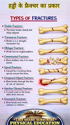 Type of Fractures 🦴 #anatomy #physicaleducation #trending