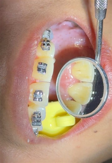 Direct Restoration of Kissing Caries on Central Incisors (11 & 21) at CES Dental Clinic🦄🦷 Watch the step-by-step process of treating kissing caries—decay that spreads between adjacent teeth—on the upper front teeth ✨ Precision and esthetics are key to a successful, seamless restoration ✨ Book your appointment now! Contact #: 0927-648-5719 FB: Ces Dental Clinic IG: @cesdentalclinic 📍 Tejero General Trias, Cavite 📍Dasmariñas, Cavite 📍 Imus, Cavite #cesdentalclinic #toothrestoration #braces #d