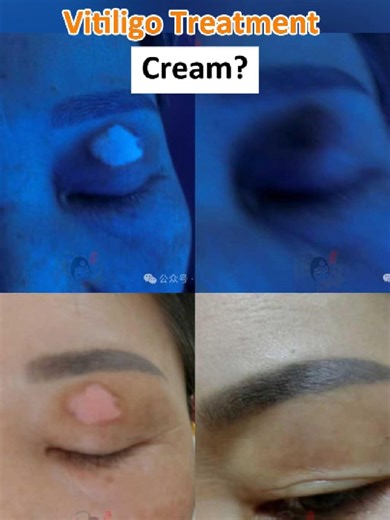 Effective Vitiligo Treatment Solutions