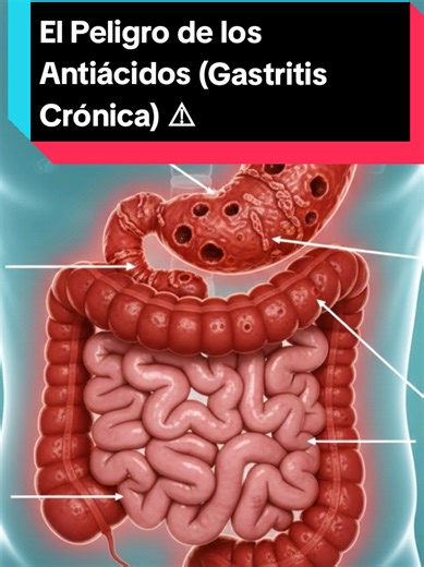 El Peligro de los Antiácidos (Gastritis Crónica) ⚠️ ​¿Llevas meses tomando protectores gástricos y tu gastritis solo empeora? Cuidado: estás apagando la alarma, pero el incendio sigue creciendo. Los antiácidos neutralizan el pH de tu estómago, impidiendo que desinfectes la comida. Esto permite que bacterias como la H. Pylori crezcan sin control. El dolor real es que al quitar el ácido, tu comida pasa entera al intestino, causando colitis, gases y una desnutrición silenciosa. ​#Gastritis #Ganoder