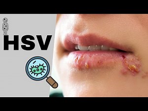Herpes Simplex Virus infection(HSV 1 & 2)