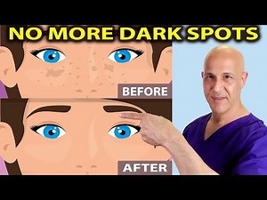 Brighten Your Skin: How to Lighten Dark Spots with Everyday Ingredients! Dr. Mandell