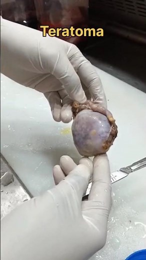 Teratoma ovary tissue | #histopathology #teratoma #ovariantumor #dermoid #cystic #ovariancyst #lab