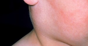 Mumps outbreak with 19 new cases across Devon in last week