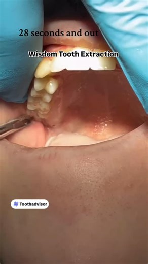 Dentistry Everyday | Think wisdom tooth extraction is always traumatic? Not necessarily. Wisdom tooth removal varies from patient to patient. It depends on the... | Instagram