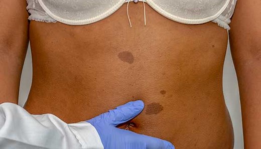 Neurofibromatosis Type 1 (NF1)