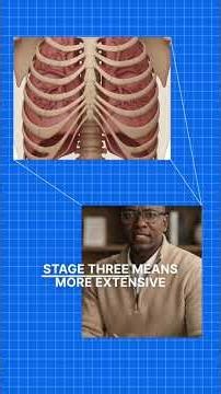 Lung Cancer Staging Explained: Stage I to IV | CHM Education