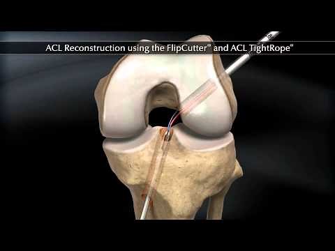 ACL Reconstruction using the FlipCutter and ACL TightRope