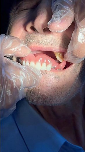 How to Reinsert or Fix Artificial Teeth After Cleaning | Easy Denture Guide for Patients#shorts #hit