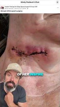 Behind The Inspire Implant Scar - Warning: Graphic Video
