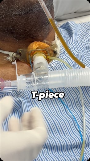 MountMedicoRN (MMRN) | T-piece is an instrument used in weaning of a patient from ventilator during spontaneous breath trials, and is widely used to identify... | Instagram