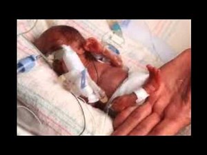 Cri Du Chat Syndrome