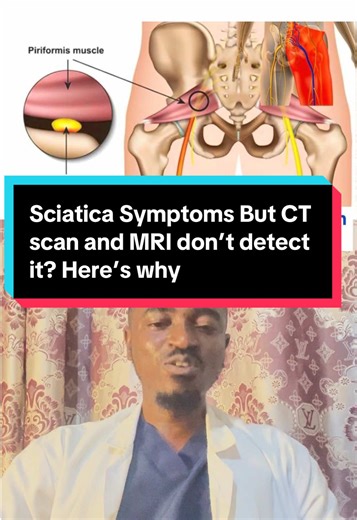 Understanding Sciatica Symptoms Not Detected by Imaging