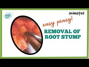 HOW TO REMOVE A ROOT PEICE || SURGICAL REMOVAL OF ROOT STUMP