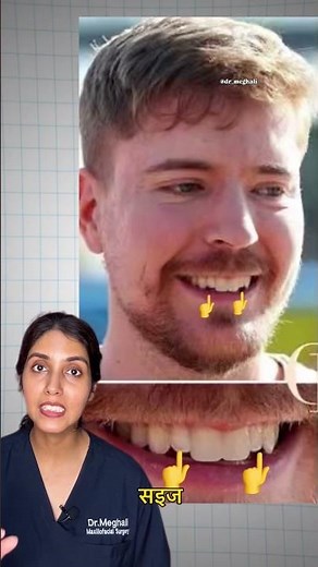 Why Mr Beast’s Smile looks weird? #mrbeast #smiledesigndental #uniquesmiles #dentalveneers #teeth