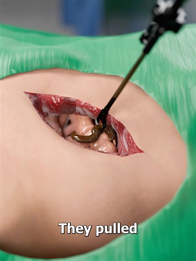 The Eel That Lived Inside a Human Body