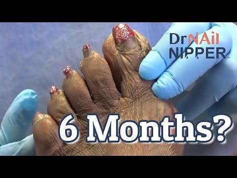 How does she wear her shoes with toenails this long? (2020)