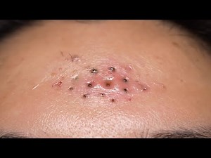 Deep Pore Cleansing: Grossly Satisfying Blackhead Extraction 🧼✨