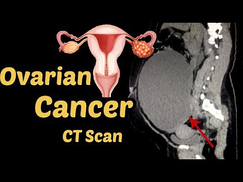 Ovarian Cancer Diagnosis CT Scan | Radiology