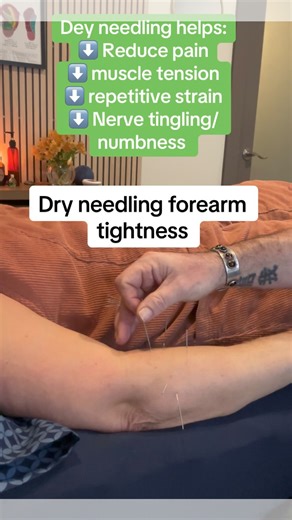 Typing all day at a computer can overload the forum muscles that move your fingers and wrist. Over time they stay tight, irritated, and don’t fully relax. Dry needling helps calm those trigger points and helps the muscles reset naturally. #dryneedlingcarpaltunnelsyndrome #acupuncturist #forearmtightness | Common Roots Acupuncture