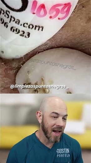 Dermatologist Reacts to Professional Spa Extractions - Sac Dep Spa Technique Review