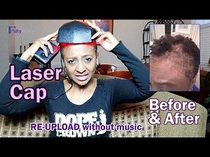 LASERCAP - 1 YR LATER on BLACK HAIR - BEFORE & AFTER / TV Blake Review