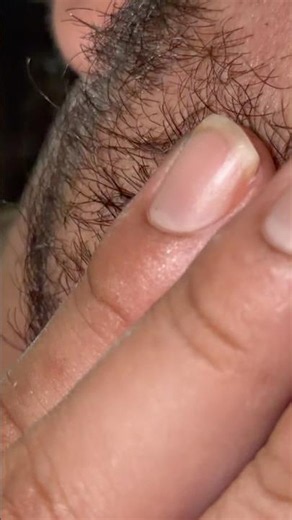 #thebarbersarms #satisfying #oddlysatisfying #pimple #blackheadcaique #relax #blackheads