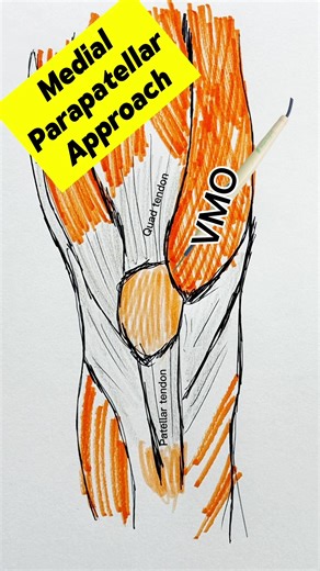 🦴 Understanding the most common knee replacement approach In this video, I demonstrate the medial parapatellar approach, the most commonly used surgical technique for total knee replacement. After a vertical skin incision, deeper tissues are exposed, including the quad muscle, quad tendon, patella, and patellar tendon. A deeper incision is then made next to the quad tendon, around the kneecap, and next to the patellar tendon to allow access to the knee joint. This approach offers excellent expo