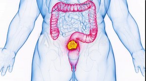 3D rendered medical animation of a malignant growth in a man's rectum.