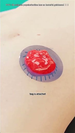 Ever Wonder How a Colostomy Surgery Works?#Colostomy #ColostomySurgery #PatientEducation