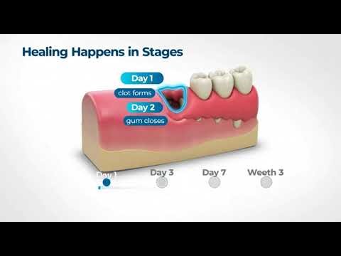 🦷 How Long Does It Take to Heal After a Tooth Extraction?
