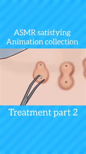 ASMR Treatment Part 2: Satisfying Sounds for Relaxation