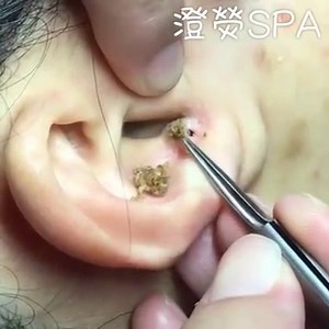 We Have Questions About This Ear Blackhead Removal Video