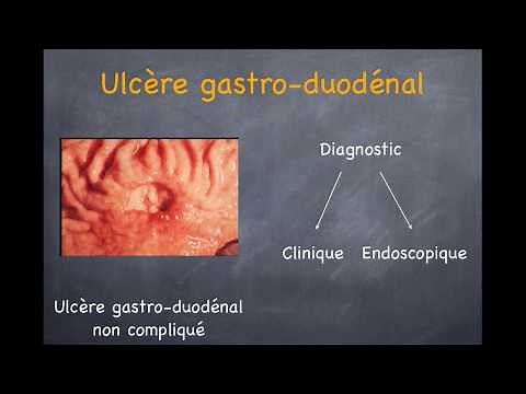 Ulcère gastrique et duodénal. Gastrite