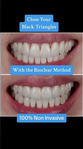 Close Your Black Triangles With the Bioclear Method 100% Non Invasive