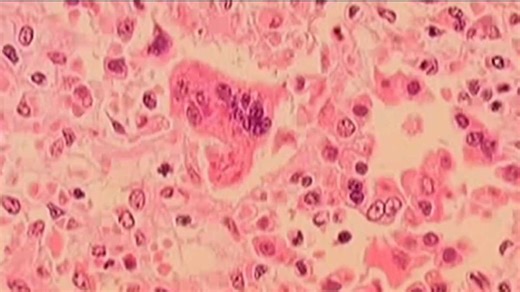 Officials: Infant in Coastal Georgia contracts measles