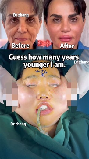 Dr.zhang on Instagram: "Deeply repairs the skin‘s foundation, reduces wrinkles, and restores facial contours! #Facelift #AntiAging #FacialRejuvenation"