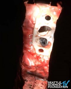 Live Demo: Single Position Multilevel Surgery Including L5/S1 (L3-S1) - J. Alex Thomas, M.D. & Jana VanAmburg, M.D. #seattlesciencefoundation #ssftv #lateralspine #spine #spinesurgeon #surgeon #spinalcord #spinetrauma | Seattle Science Foundation