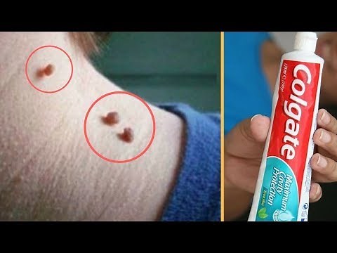 REMOVE SKIN TAG IN 1 NIGHT BY APPLYING TOOTHPASTE ||
