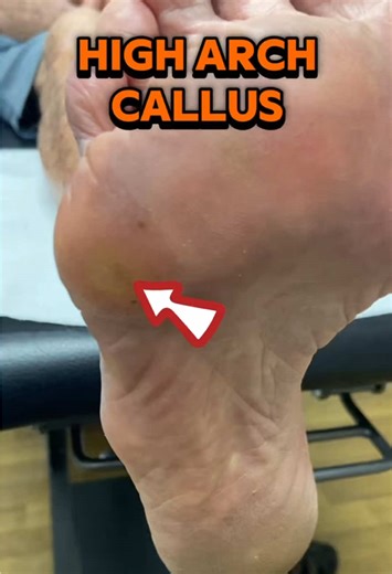 A satisfying treatment today removing a painful callus under the plantar fifth metatarsal head, with another developing under the plantar first metatarsal head. This patient is a great example of how foot structure directly influences pressure and function. They have a high-arched (cavus) foot, with a high medial arch, lateral arch, and transverse arch. Because of this shape, pressure tends to concentrate on the first and fifth metatarsal heads, while the second, third, and fourth metatarsals ca