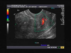 cervical polyp of uterus- ultrasound and color Doppler imaging
