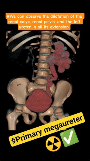#Case of a primary megaureter ☢️CE-CT Abdomen #shortvideo