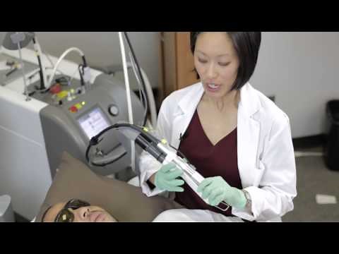 Laser Hair Removal with NdYAG 1064nm Laser, Skin Type IV VI